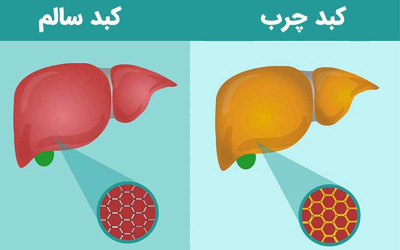 کبد چرب و کبد سالم