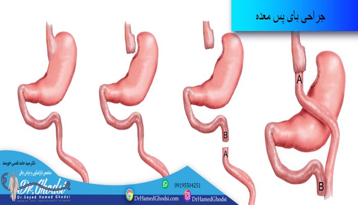 جراحی بای پس معده