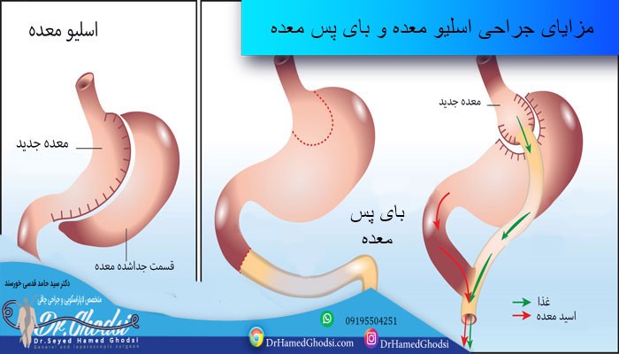 بهبودی پس از جراحی بای پس معده و اسلیو معده