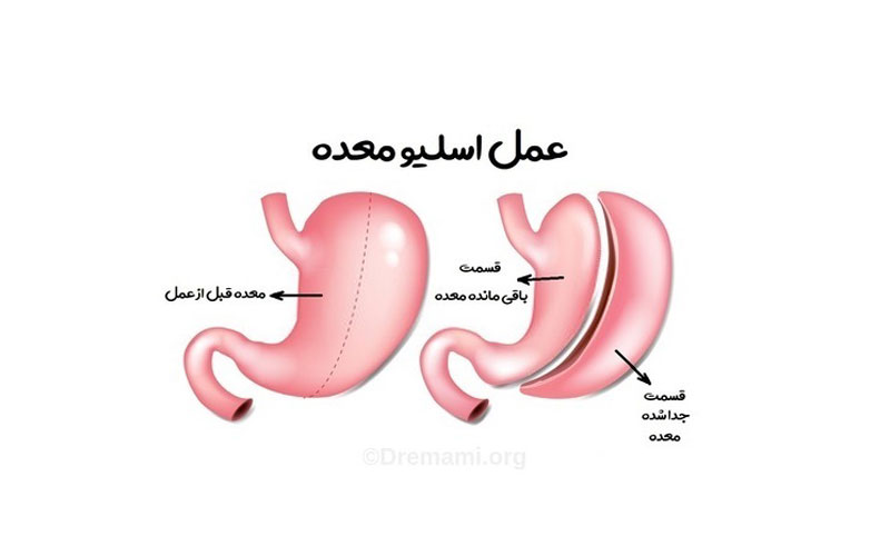 عمل اسلیو معده