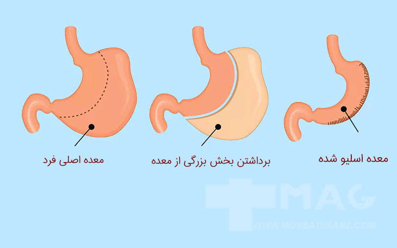 چگونگی انجام اسلیو معده