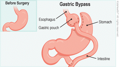 جراحی بای پس معده
